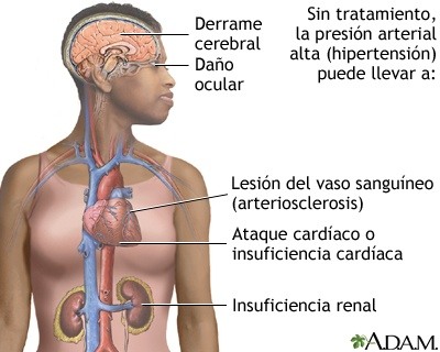 Hipertensión